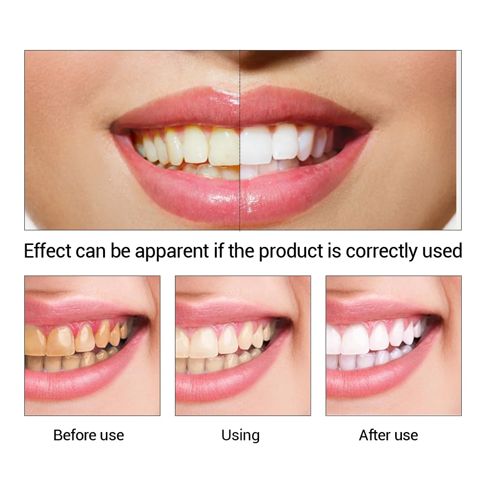 FTEENPLY Zahnaufhellung Essenz – Teeth Whitening Quotes Bewertung und Preis