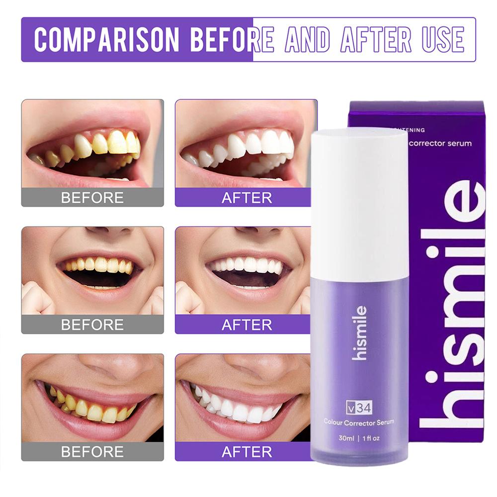    Lila V34 Hismile Zahnaufhe – Teeth Whitening Crest Bewertung und Preis
