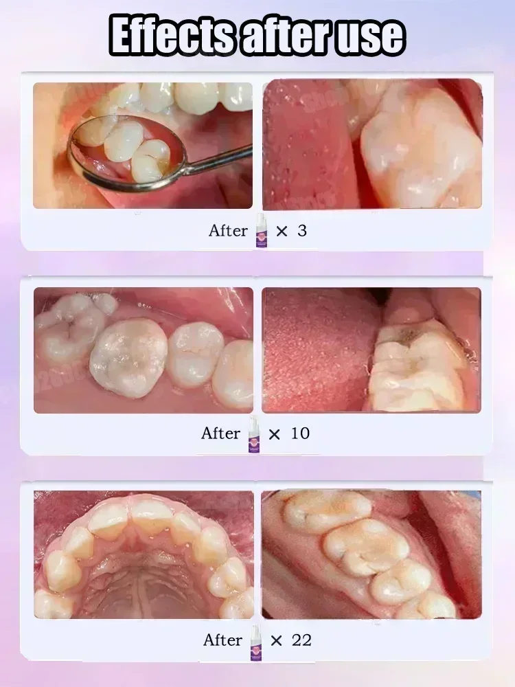 Zahnreinigungs-Zahnpasta entfe – Teeth Whitening Treatment Bewertung und Preis